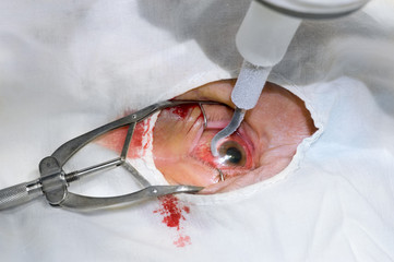 כמה עולה ניתוח לייזר להסרת משקפיים